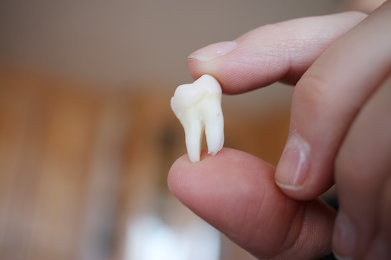 Read more about the article 缺牙一定要植牙嗎？牙醫師說明缺牙的問題