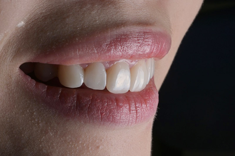 DSD微笑設計 / 隱適美矯正 / 牙齦整形術 / 美學貼片 – 案例3
