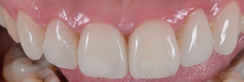 牙齒怎麼變白？牙齒美白方法大解析，讓您奪回人生自信心