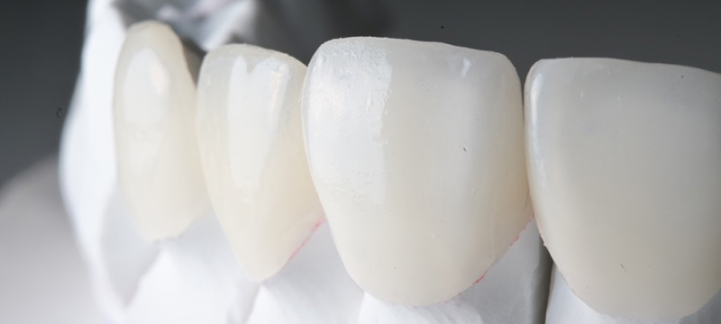 Read more about the article 陶瓷貼片是什麼？