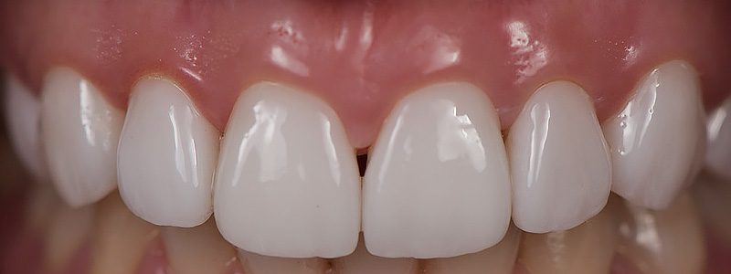 DSD微笑設計 / 牙齦整形術 / 美學貼片 – 案例1
